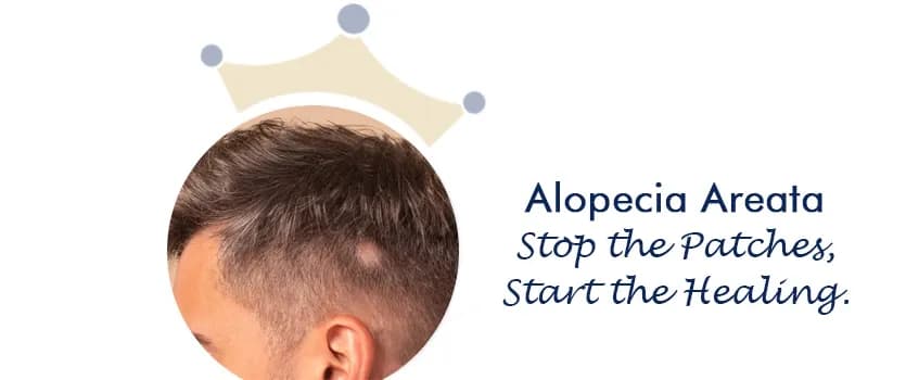Alopecia areata treatment in Ahmedabad